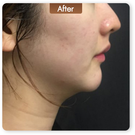 Liftera Advanced HIFU หลังทำ ปรับกรอบหน้าและเก็บแก้ม
