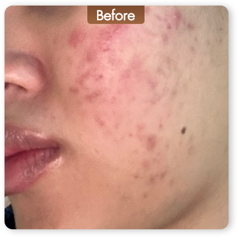 Fractional CO2 Laser ก่อนทำ ปัญหาสิวและรอยสิวบนผิวหน้า