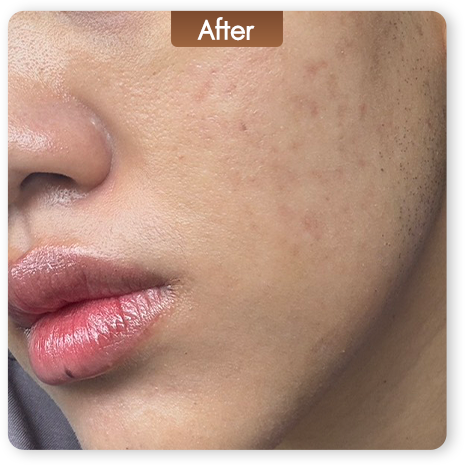Fractional CO2 Laser หลังทำ ผิวหน้าเรียบเนียนและรอยสิวดูจางลง
