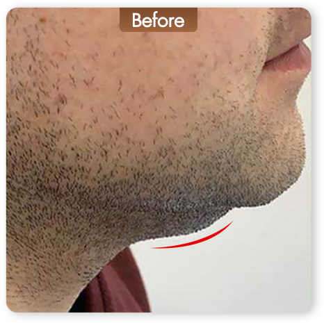 Liftera Advanced HIFU ก่อนทำ เก็บเหนียงและปรับกรอบหน้า