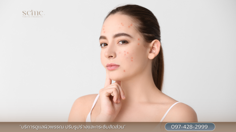 สิว รอยสิว