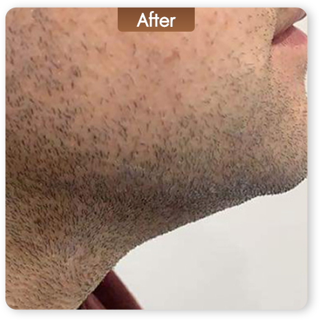 Liftera Advanced HIFU หลังทำ เก็บเหนียงและกระชับกรอบหน้า