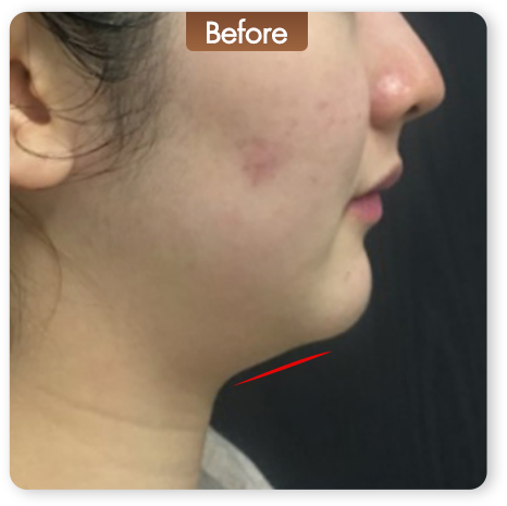 Liftera Advanced HIFU ก่อนทำ ปรับกรอบหน้าและเก็บแก้ม