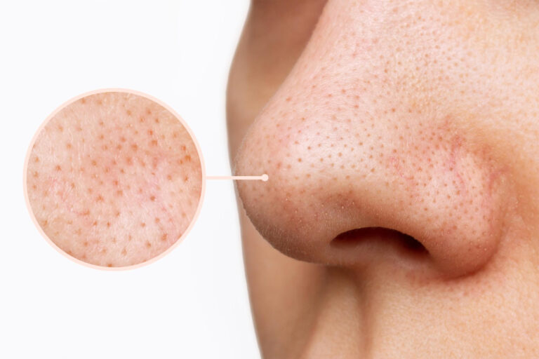 Enlarged pores