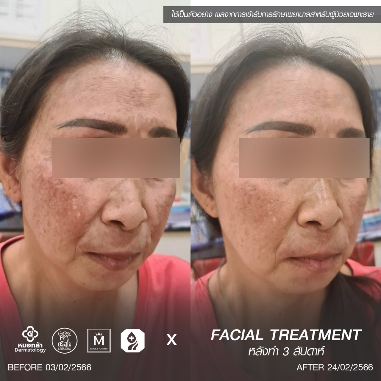 รีวิวหลังทำวิตามินดริปผิว 3 สัปดาห์