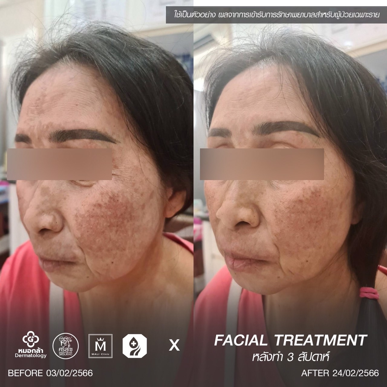 หลังทำวิตามินดริปผิว 3 สัปดาห์