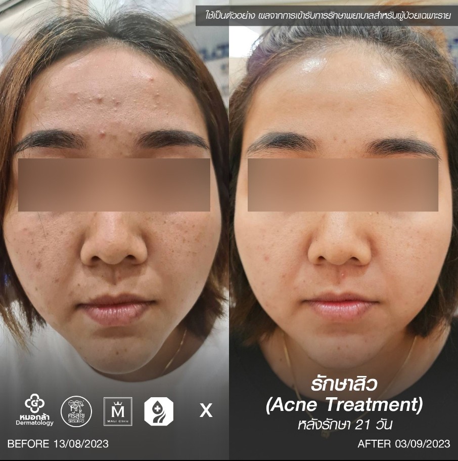 รีวิวหลังรักษาสิว 21 วัน