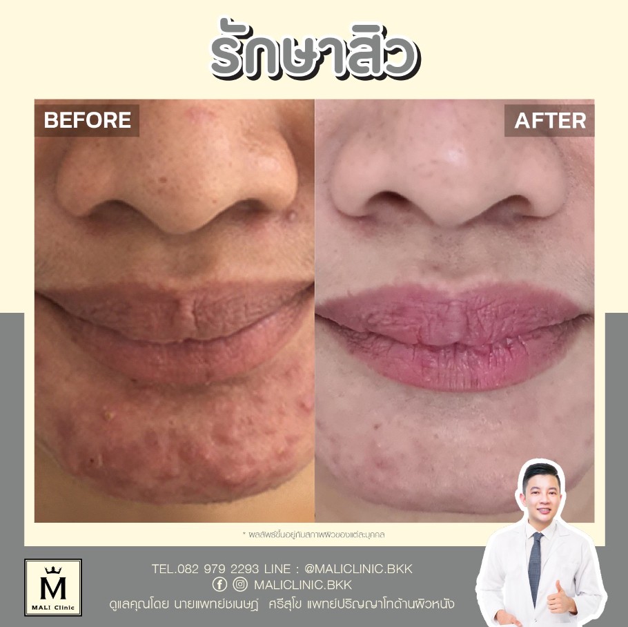 รีวิวการรักษาสิวที่คาง