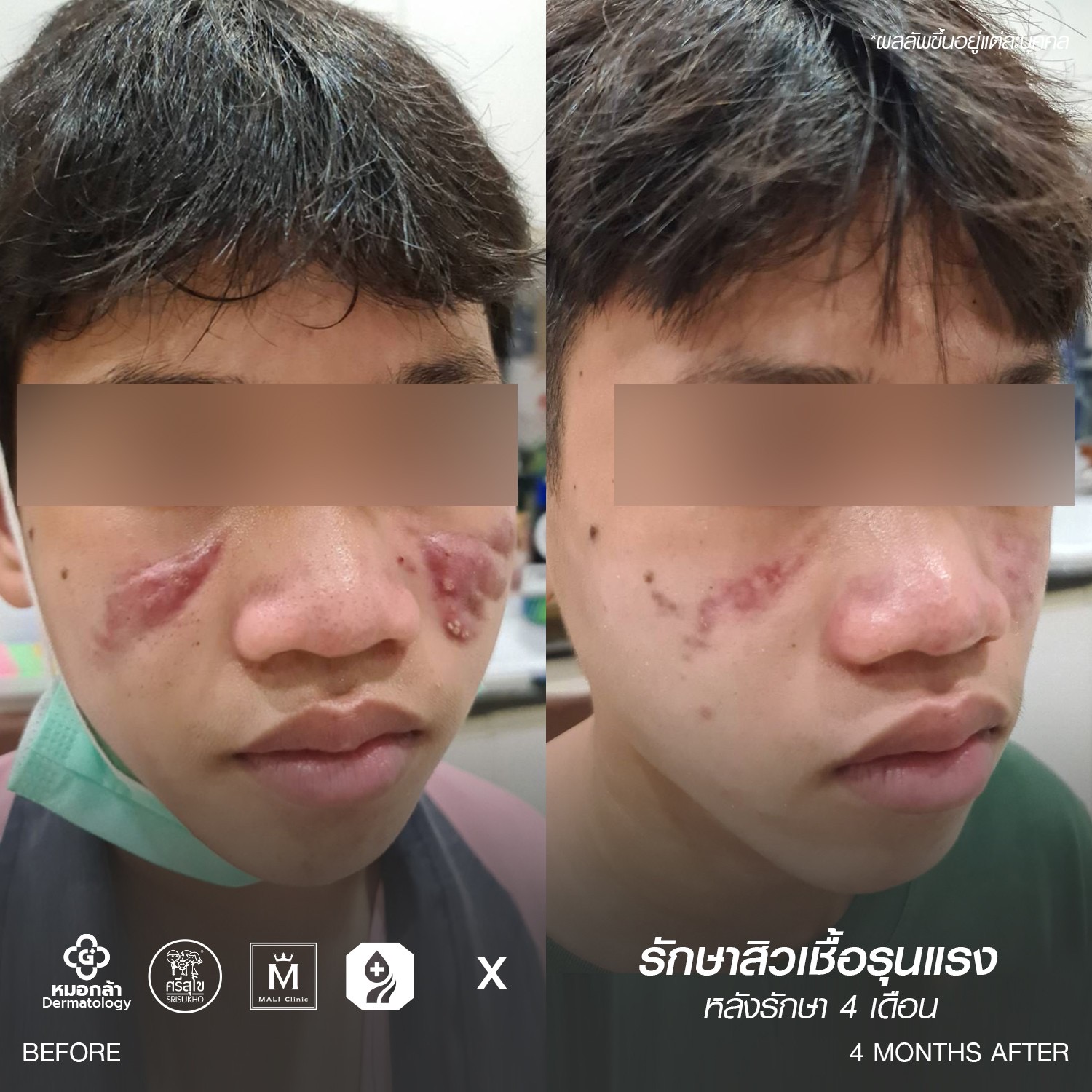 รักษาสิวเชื้อรุนแรง