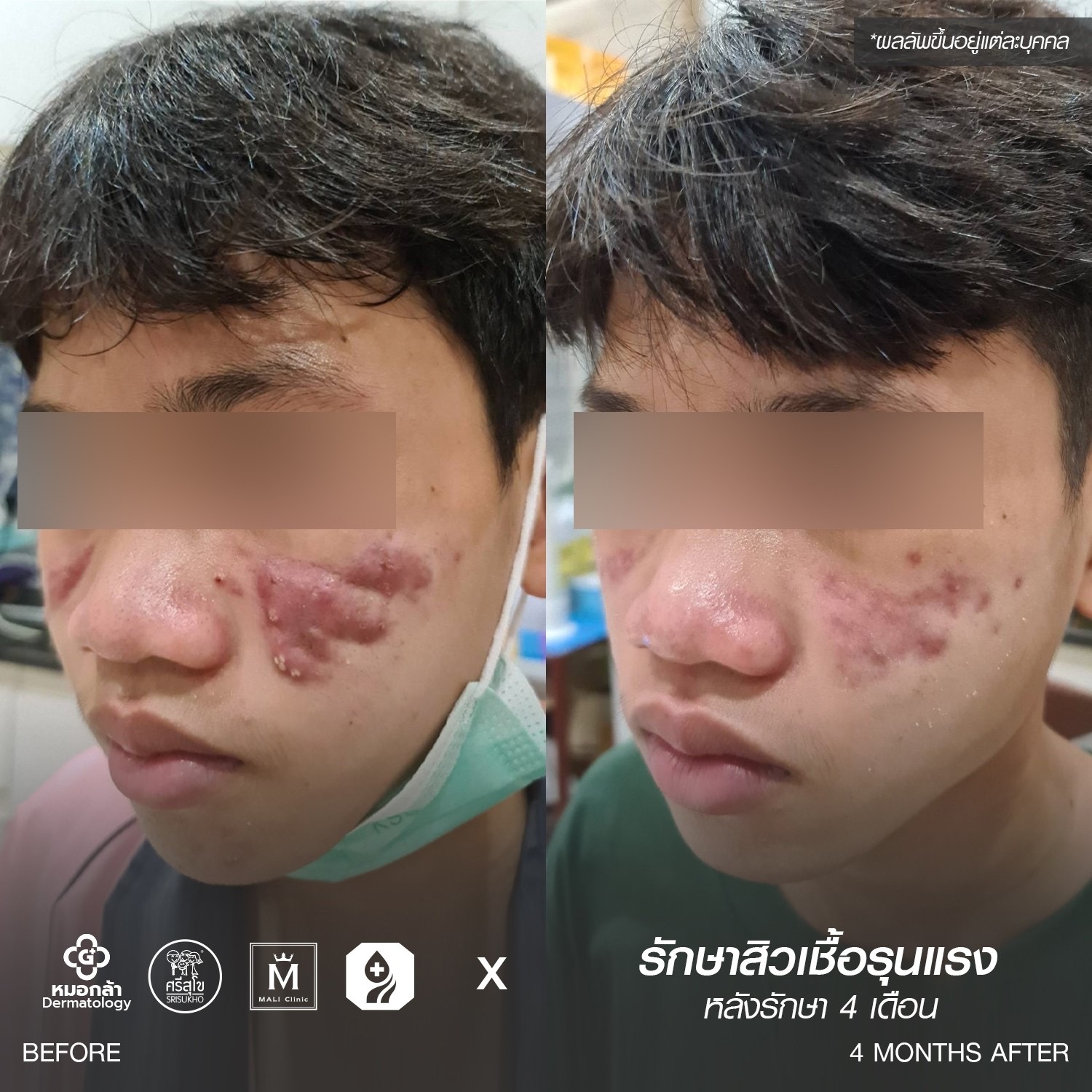 รีวิวหลังรักษาสิว 4 เดือน