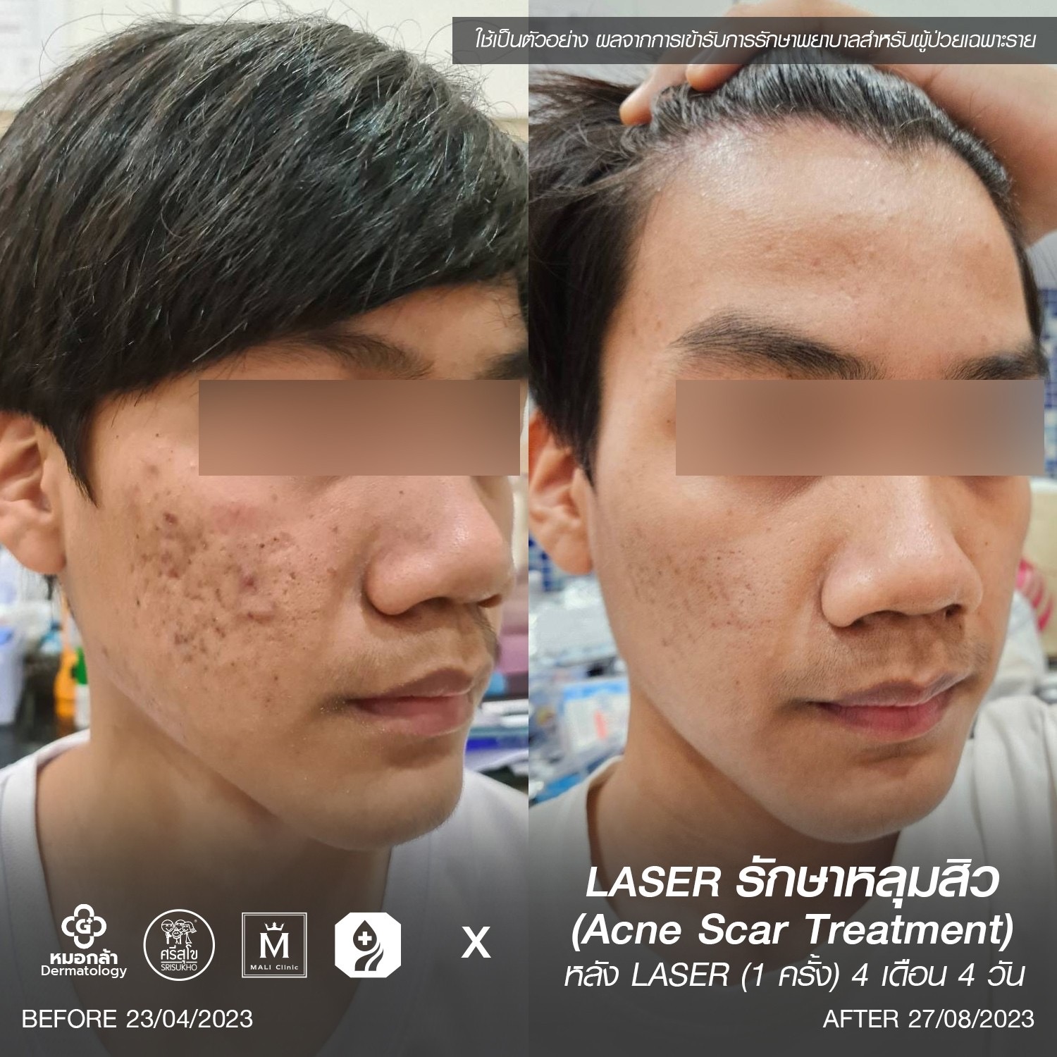 รีวิวเลเซอร์รักษาหลุมสิว