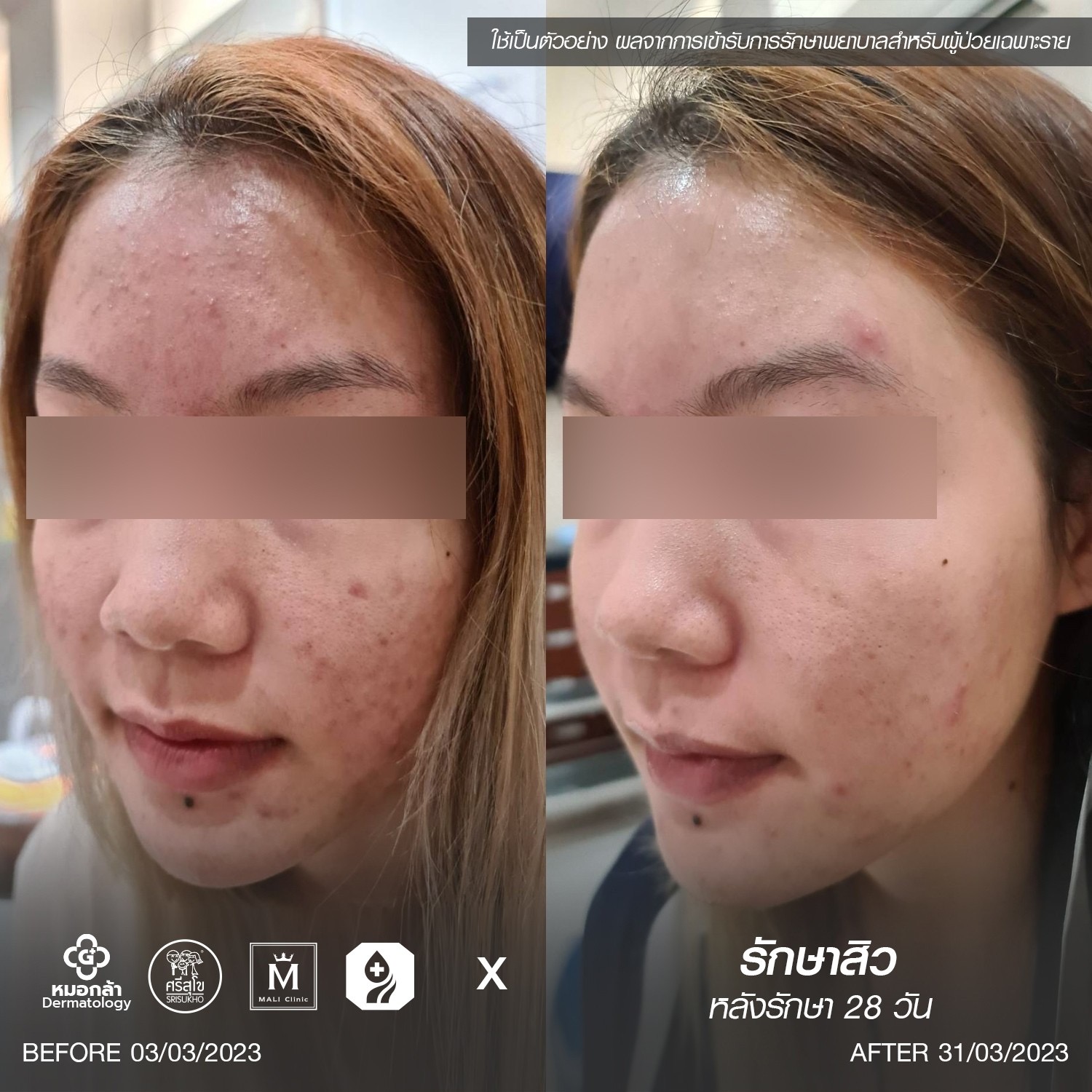 รีวิวหลังรักษาสิว 28 วัน