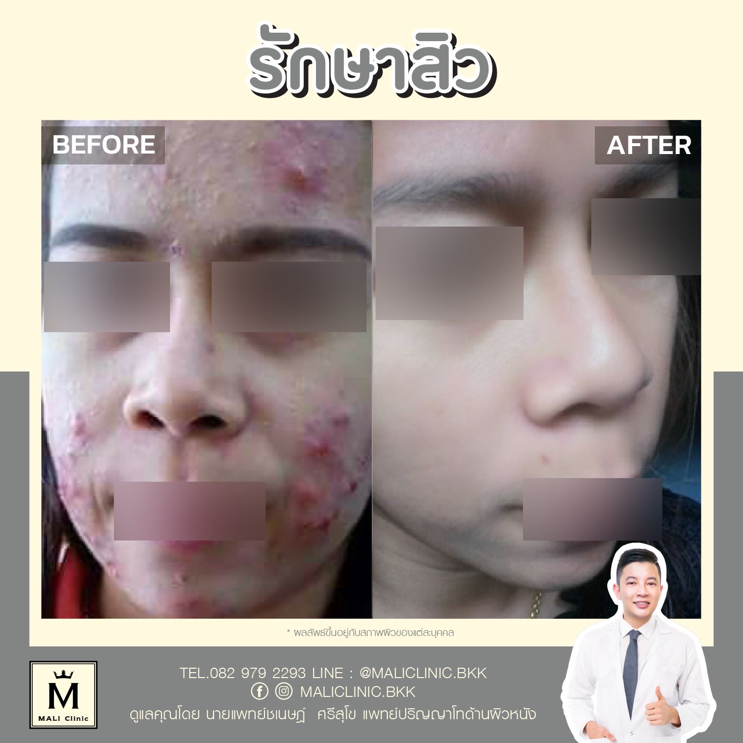 รีวิวการรักษาสิว