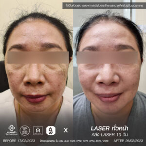 Review-laser8