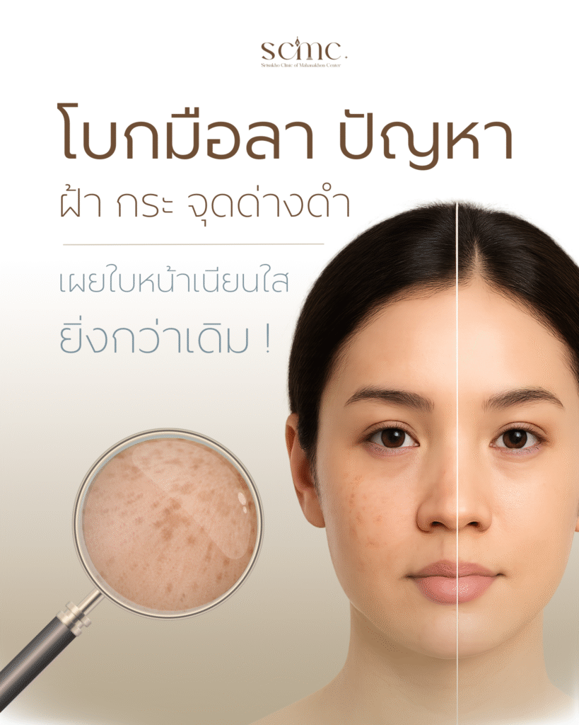 ปัญหาฝ้า กระ จุดด่างดำ_0