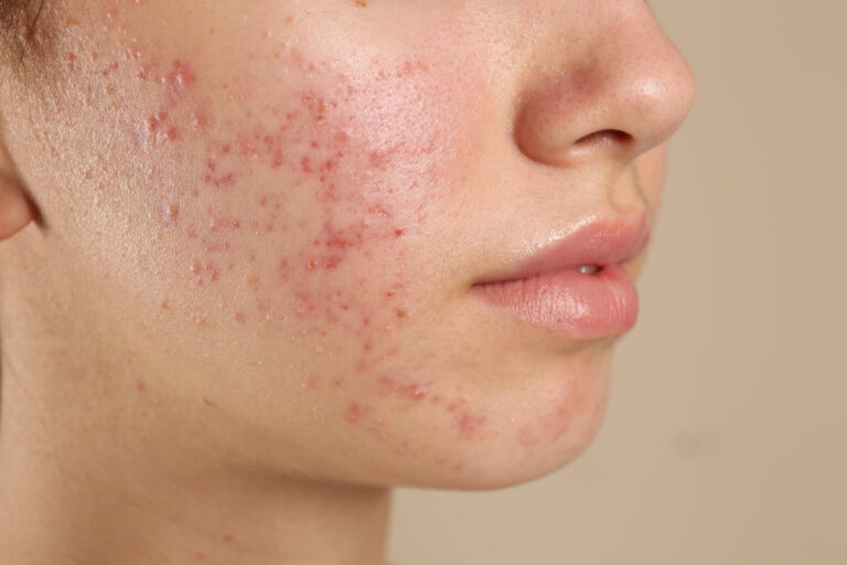 Inflamed acne