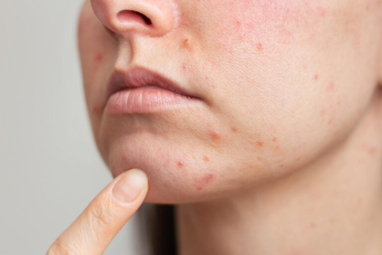 acne