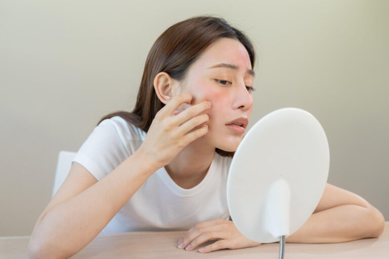 dry skin