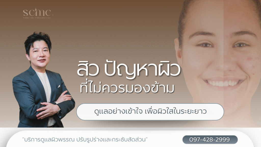 สิว ปัญหาผิวที่ไม่ควรมองข้าม ดูแลอย่างเข้าใจ เพื่อผิวใสในระยะยาว