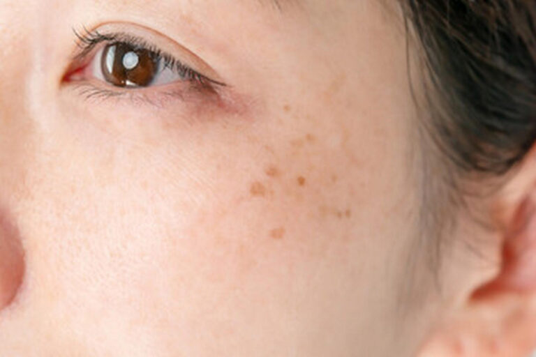 Dark spots on the face