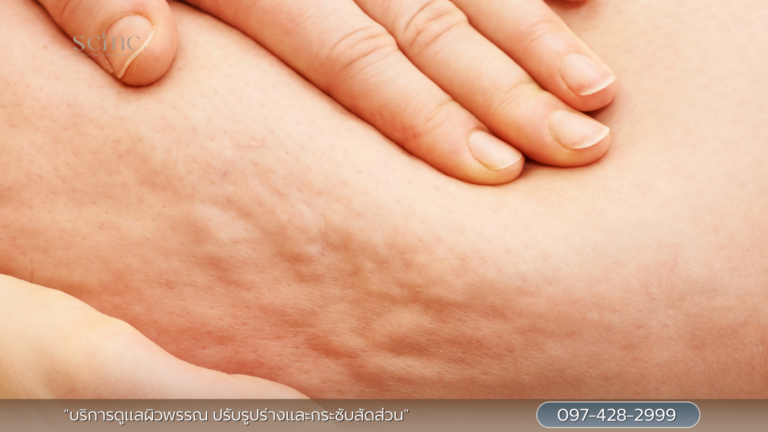 ผิวเซลลูไลท์