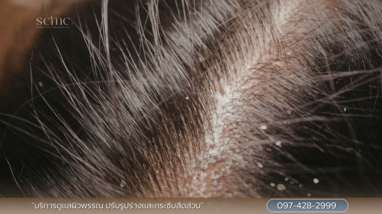 หนังศรีษะ